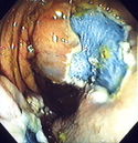 Endomucosal resection 4.jpg